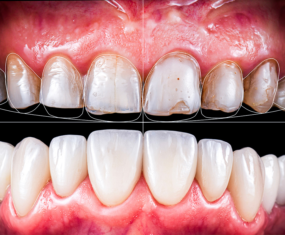 Smile Designing Process